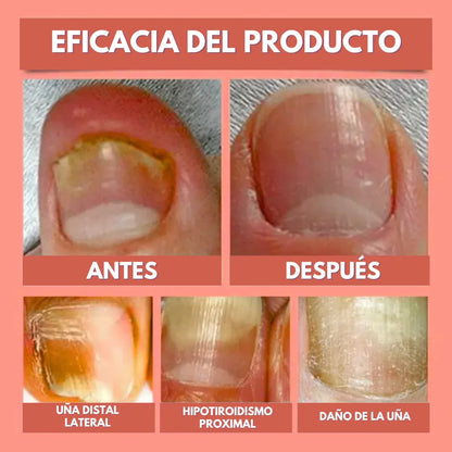 DermaPatch™ Parche Antifúngico para Hongo